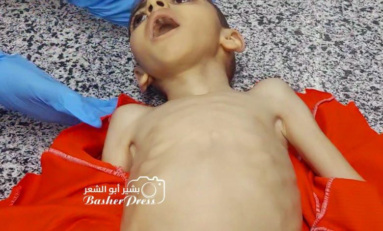 A 4-year-old boy, Mustafa Mohammed Yassin, died of severe malnutrition and dehydration at Al-Ahli Baptist Hospital in Gaza on Saturday.